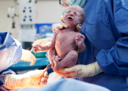 Long-Term Effects of C-Section